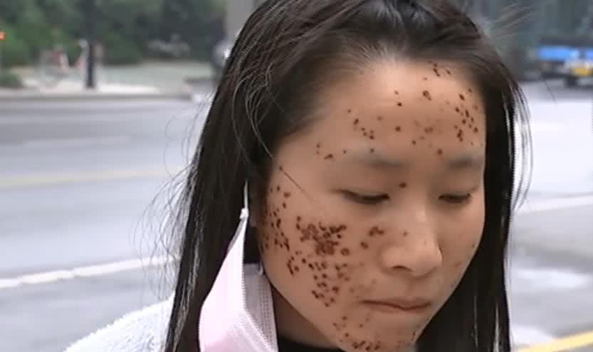 祛痘产品致脸毁容，该找谁负责？-图3