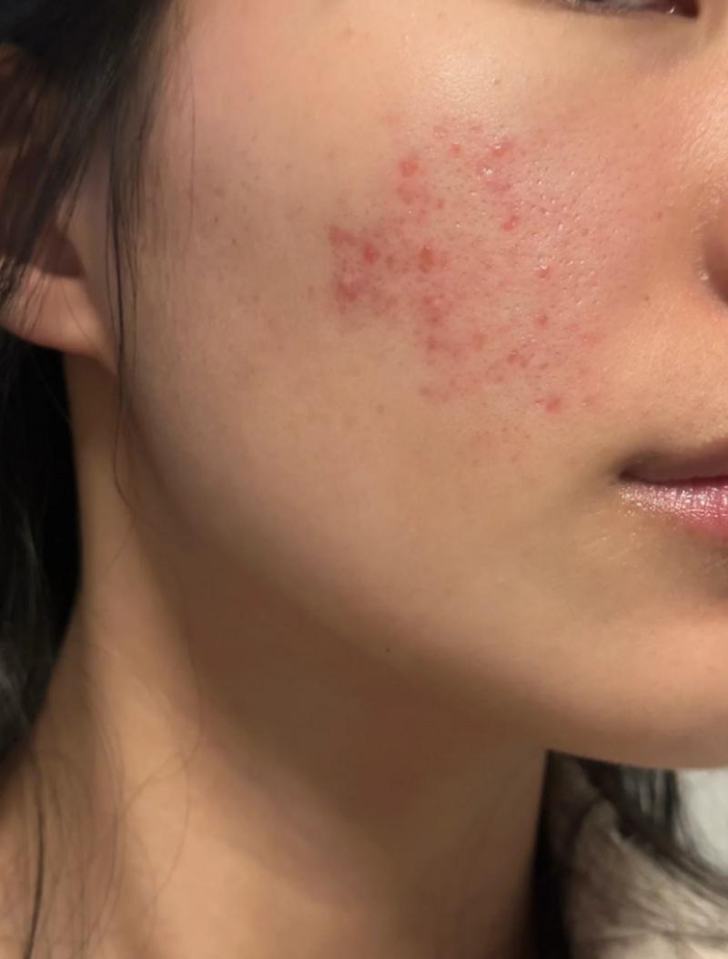 激光祛痘印效果真的好吗?-图1 激光祛痘印效果真的好吗?-图1