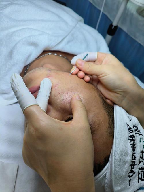 做了OPT红蓝光祛痘-图1