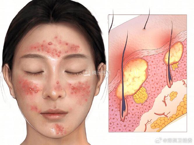 祛痘本草纲目为何不能？-图1