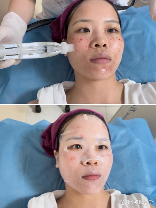 山东彩光祛痘效果怎样-图2