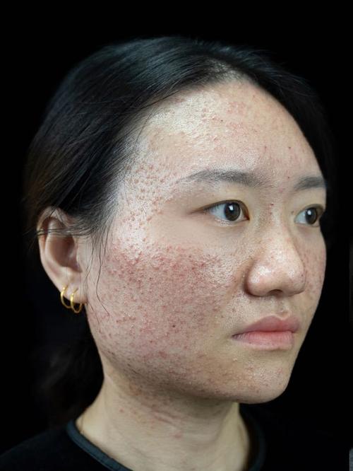 台湾激光祛痘效果到底怎么样？-图2