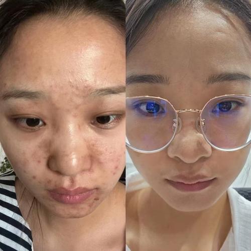 台湾激光祛痘效果到底怎么样？-图3