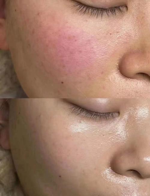 果酸换肤祛痘后为何会反弹？-图2