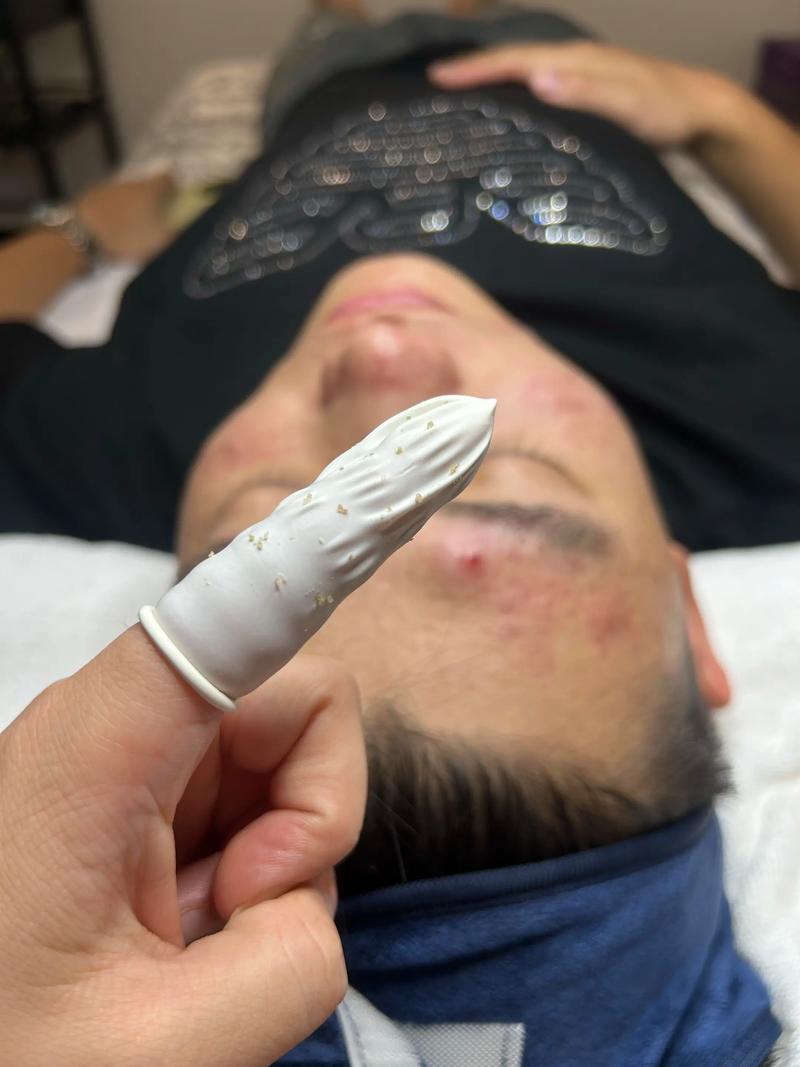 秘方祛痘药水怎么保存-图1