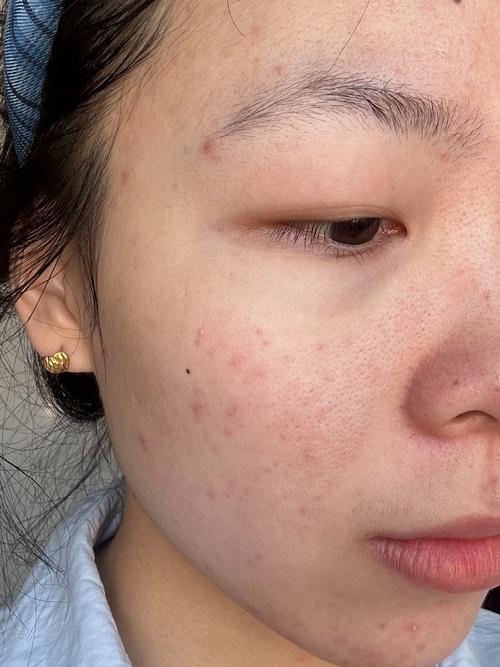 理肤泉祛痘水有沉淀还能用吗？-图2