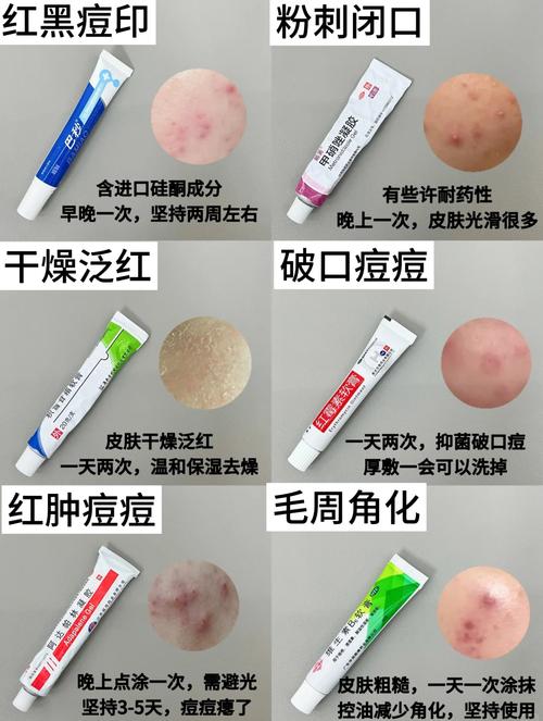 wis祛痘印凝胶过敏怎么办？-图1