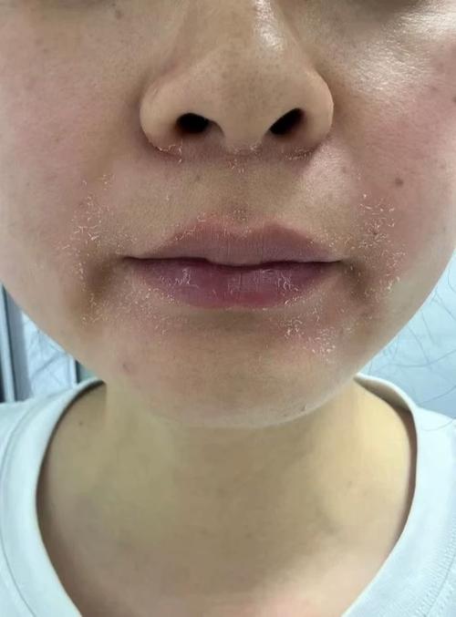 脸脱皮时能用护肤品吗？-图1
