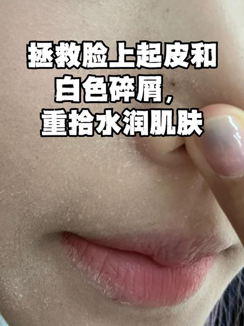 脸脱皮时能用护肤品吗？-图2