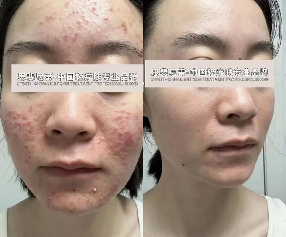 egf祛痘印效果怎样-图2