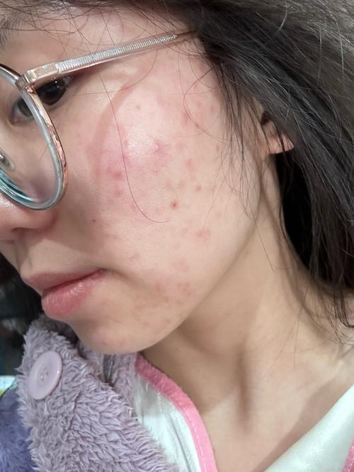 医院红蓝光祛痘后多久能沾水?-图2 医院红蓝光祛痘后多久能沾水?-图2