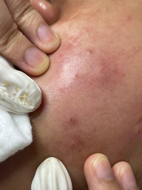 医院红蓝光祛痘后多久能沾水?-图3 医院红蓝光祛痘后多久能沾水?-图3