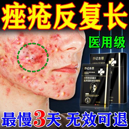 哪些消炎祛痘面膜品牌最值得选？-图2