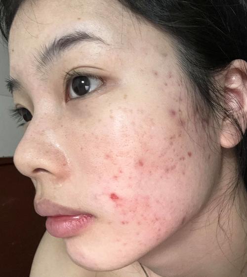 自体血清PRP祛痘印效果怎么样？-图2