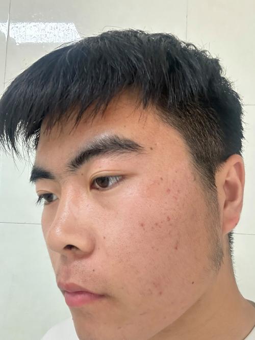 男士祛痘效果最好的方法是什么？-图2