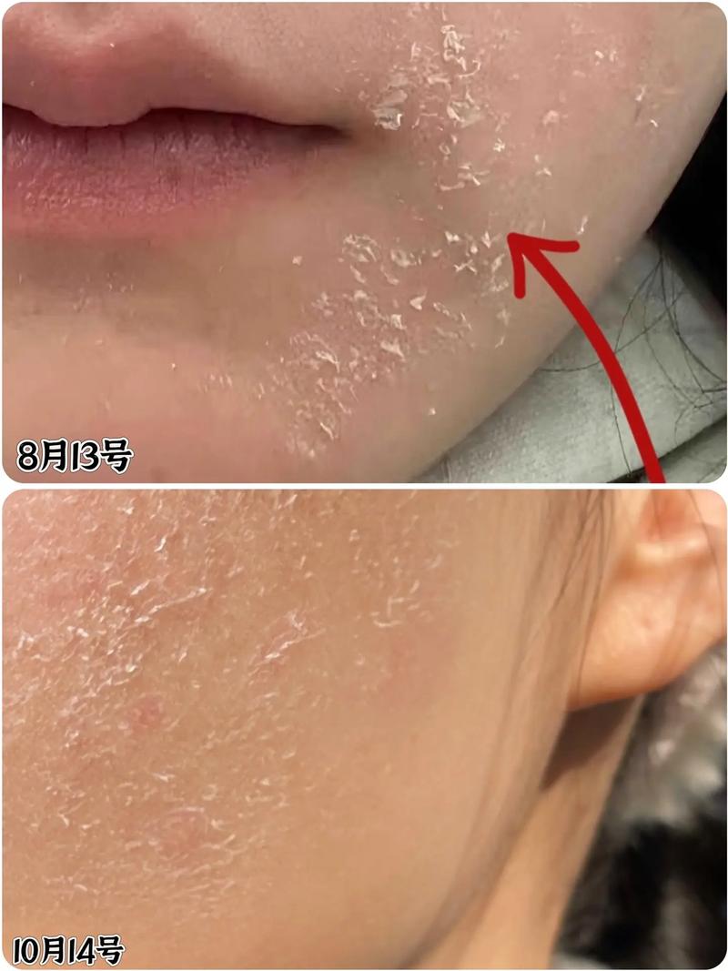 DHC祛痘精华蜕皮是正常反应吗?-图1 DHC祛痘精华蜕皮是正常反应吗?-图1