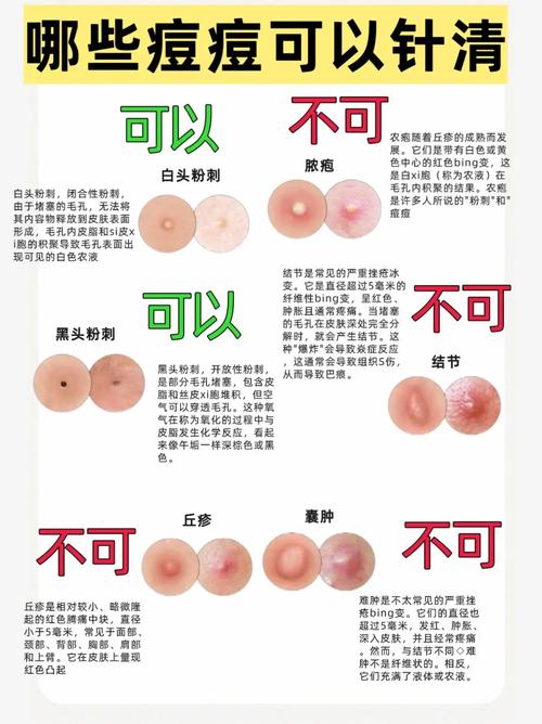 普通方法祛痘，哪种最有效？-图3