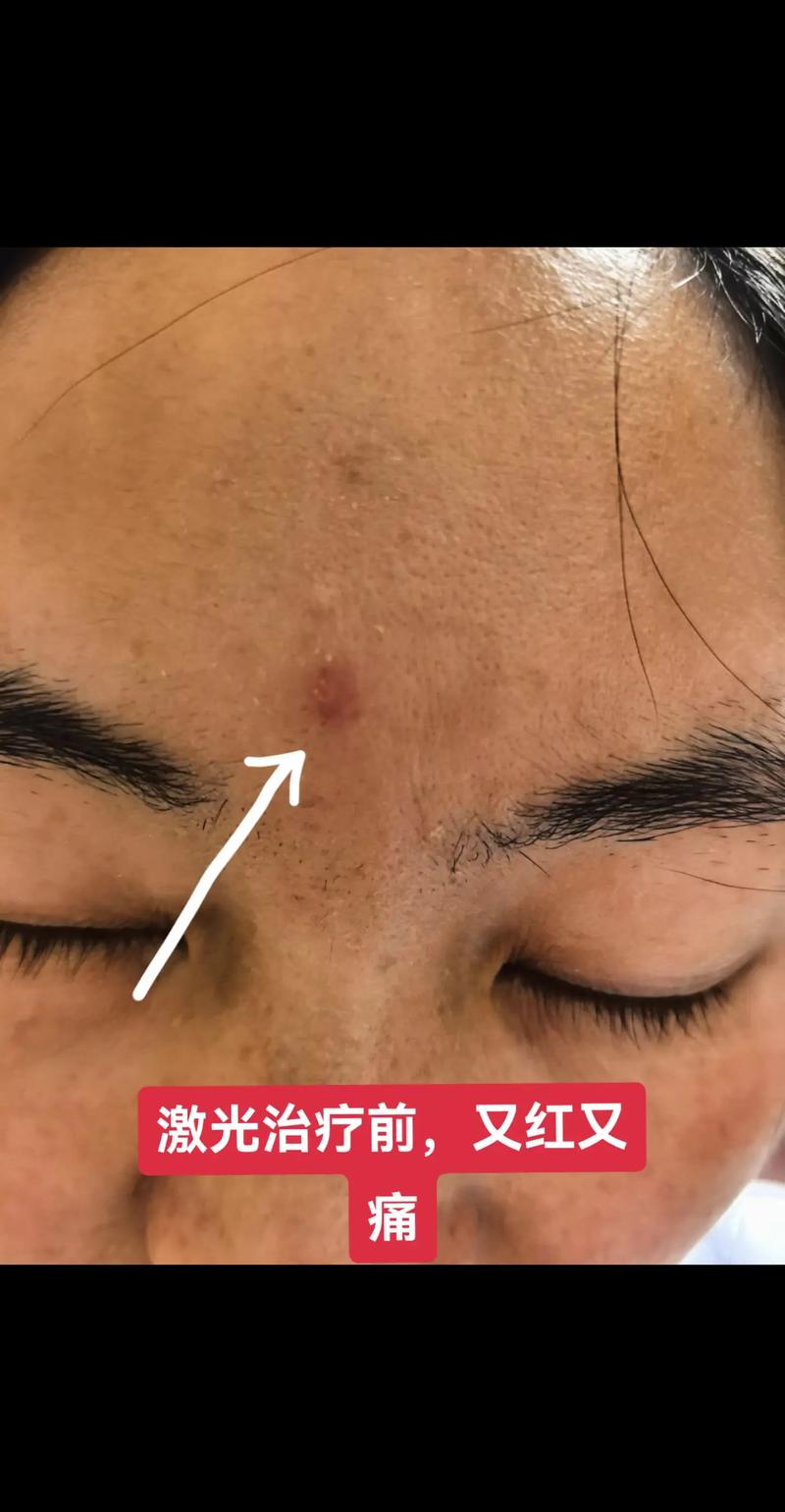 激光祛痘后悔?是坑还是没选对?-图1 激光祛痘后悔?是坑还是没选对?-图1