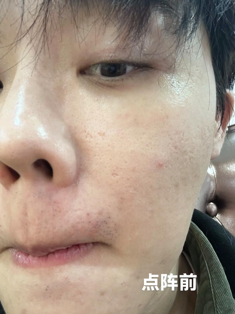 激光祛痘后悔?是坑还是没选对?-图2 激光祛痘后悔?是坑还是没选对?-图2