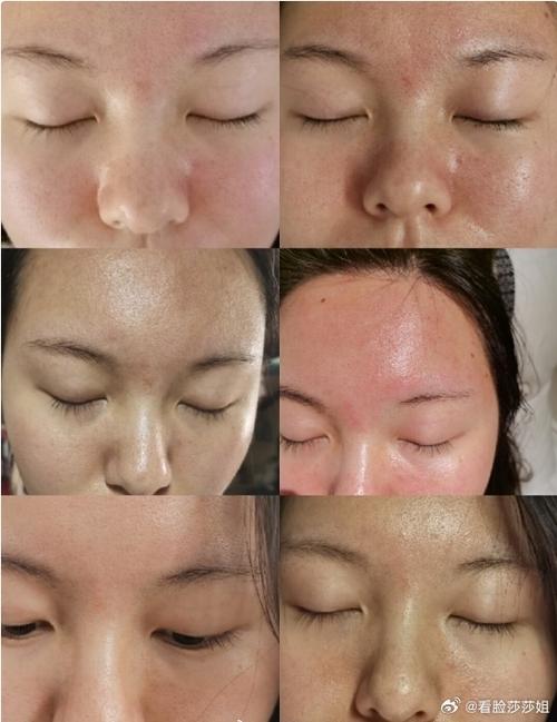 激光祛痘后悔?是坑还是没选对?-图3 激光祛痘后悔?是坑还是没选对?-图3