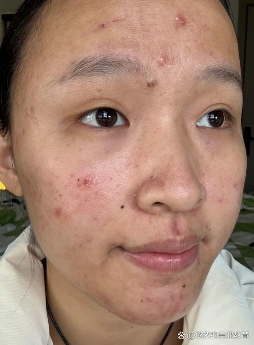 妆点网曝光的祛痘产品,真的靠谱吗?-图2 妆点网曝光的祛痘产品,真的靠谱吗?-图2