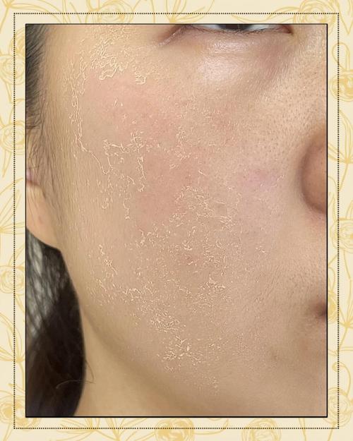 脸蜕皮,用什么护肤品修复好?-图1 脸蜕皮,用什么护肤品修复好?-图1