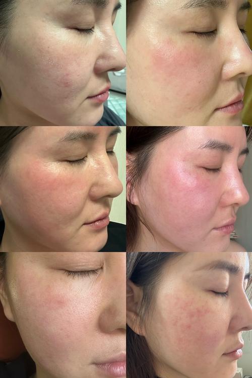 脸过敏可以涂护肤品吗-图3 脸过敏可以涂护肤品吗-图3