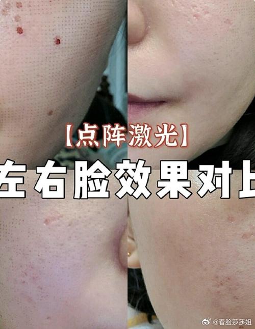 上海点阵激光祛痘印效果如何?-图1 上海点阵激光祛痘印效果如何?-图1