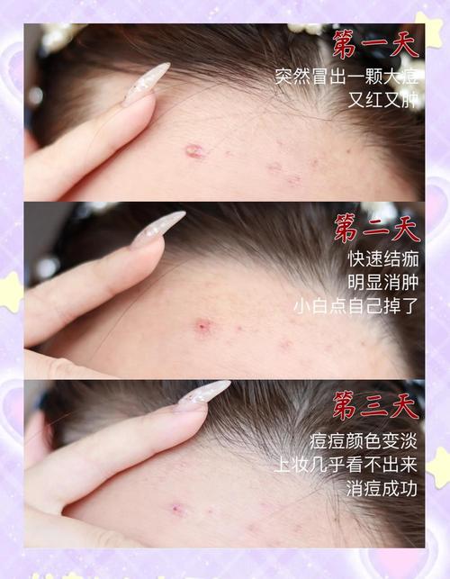 如何快速祛痘不留痘印？-图3