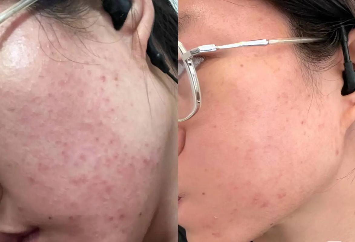 薰衣草祛痘搭配什么效果更好？-图3