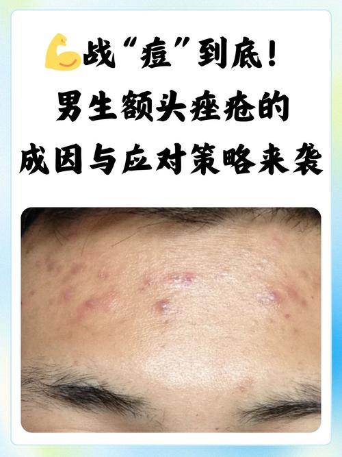 男生如何快速祛痘粉刺？-图2
