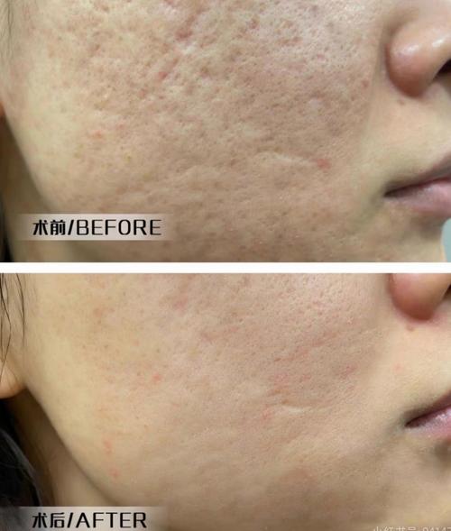 钻石微雕祛痘真能彻底根除吗？-图3