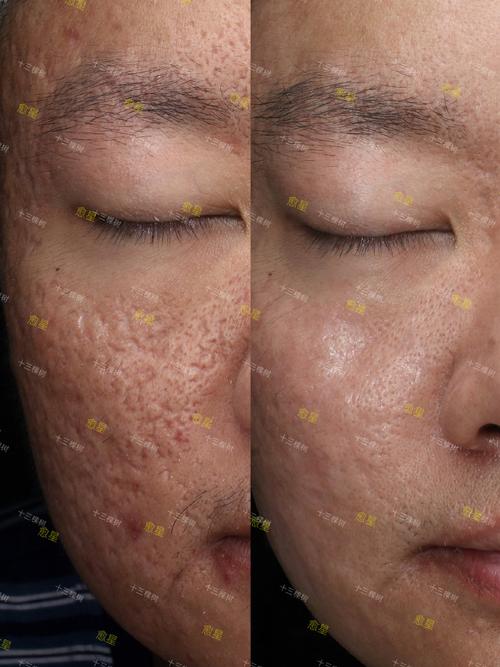 激光祛痘过程到底有多可怕？-图2