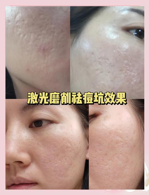 激光祛痘过程到底有多可怕？-图3