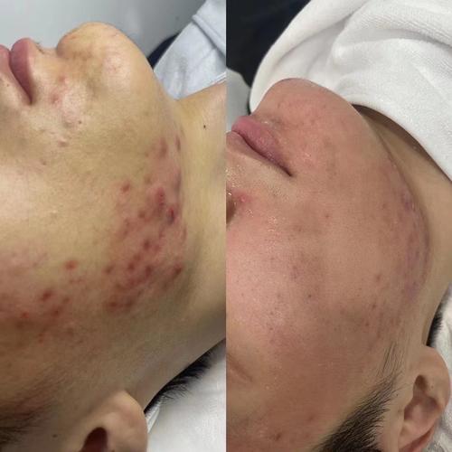 ok原液祛痘效果到底好不好？-图2