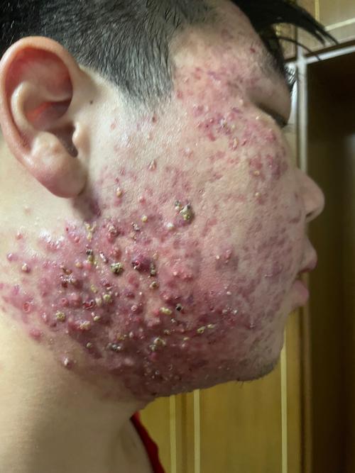 自然乐园栗子AC祛痘效果怎么样？-图2