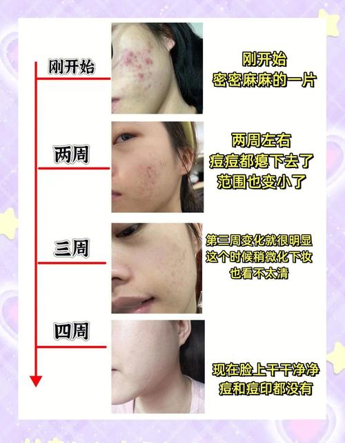 祛痘产品怎么介绍才让人信服？-图1