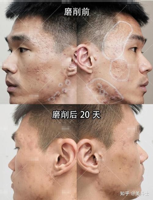 激光祛痘印常用哪些激光类型？-图2