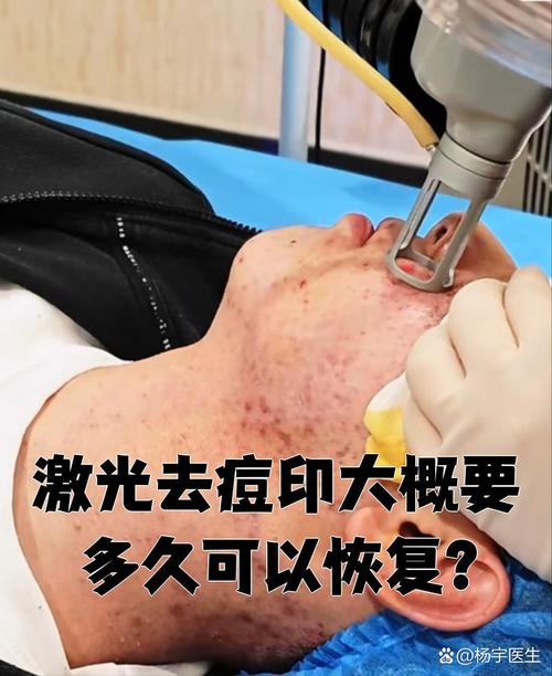 激光祛痘印常用哪些激光类型？-图1