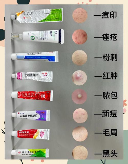 祛痘药膏用后皮肤干怎么办？-图2