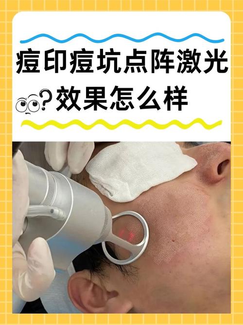 激光祛痘多久能见效?-图2 激光祛痘多久能见效?-图2