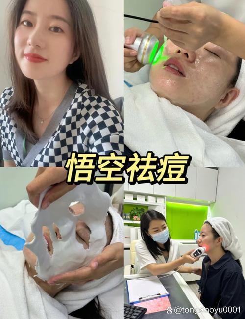 激光祛痘多久能见效？-图3