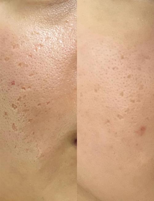 激光祛痘后为何会色素沉着?-图1 激光祛痘后为何会色素沉着?-图1