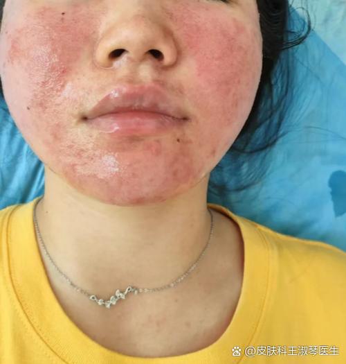 护肤品用后脸刺痛是为什么？-图2