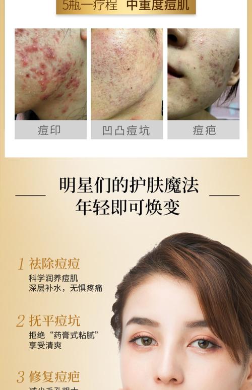 对闭口痘有效的护肤品-图2 对闭口痘有效的护肤品-图2