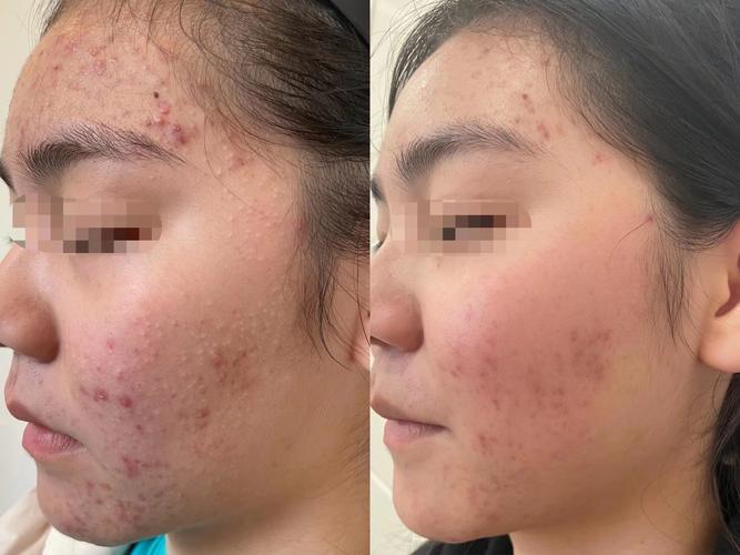 自然美为何会增痘而非祛痘？-图1