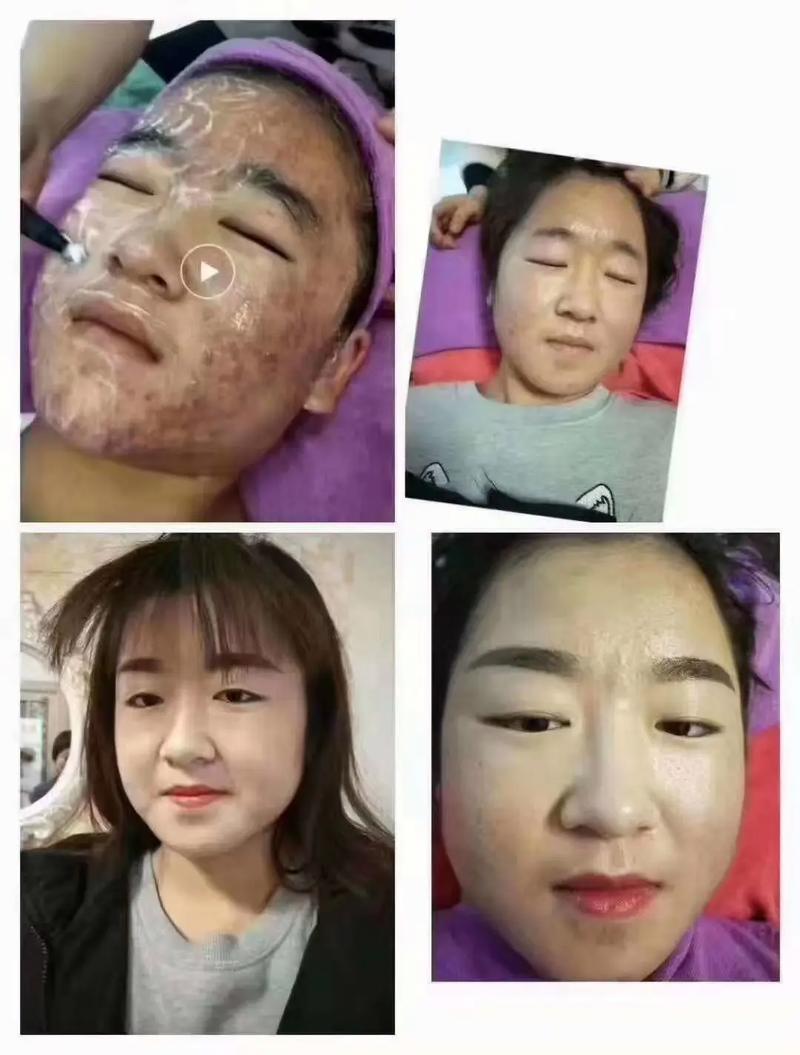 美容院祛痘祛斑为何不靠谱?-图3 美容院祛痘祛斑为何不靠谱?-图3
