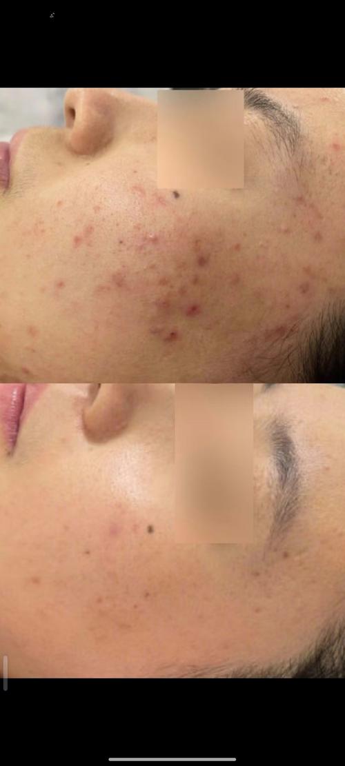 哪款护肤品能闭合性粉刺？-图1