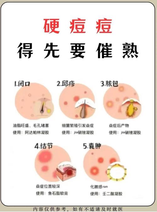 祛痘机构先挤痘有用吗-图1