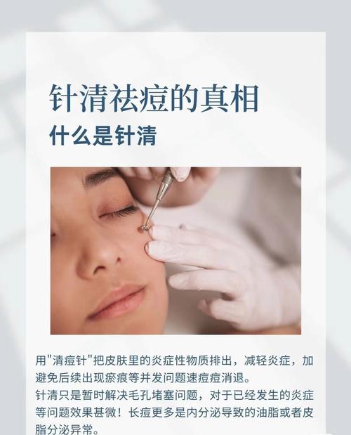 祛痘机构先挤痘有用吗-图2